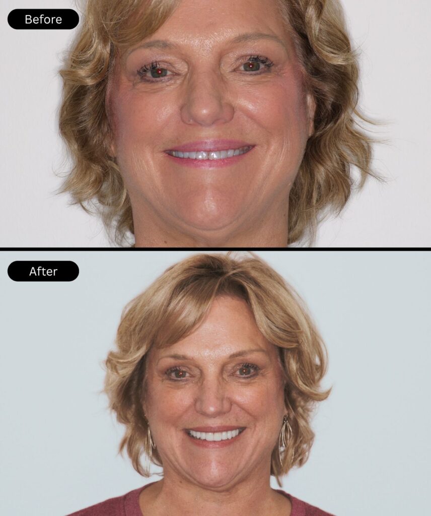 before-after