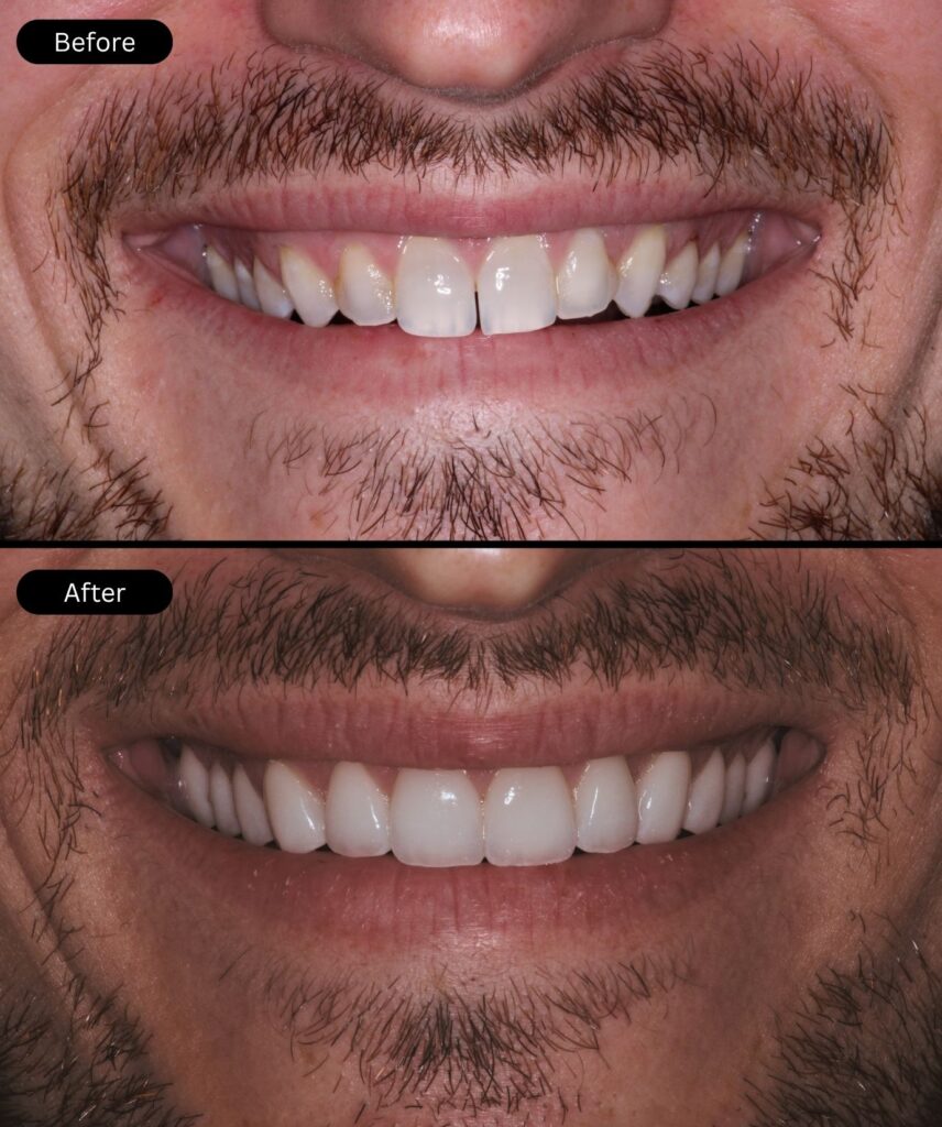 before-after