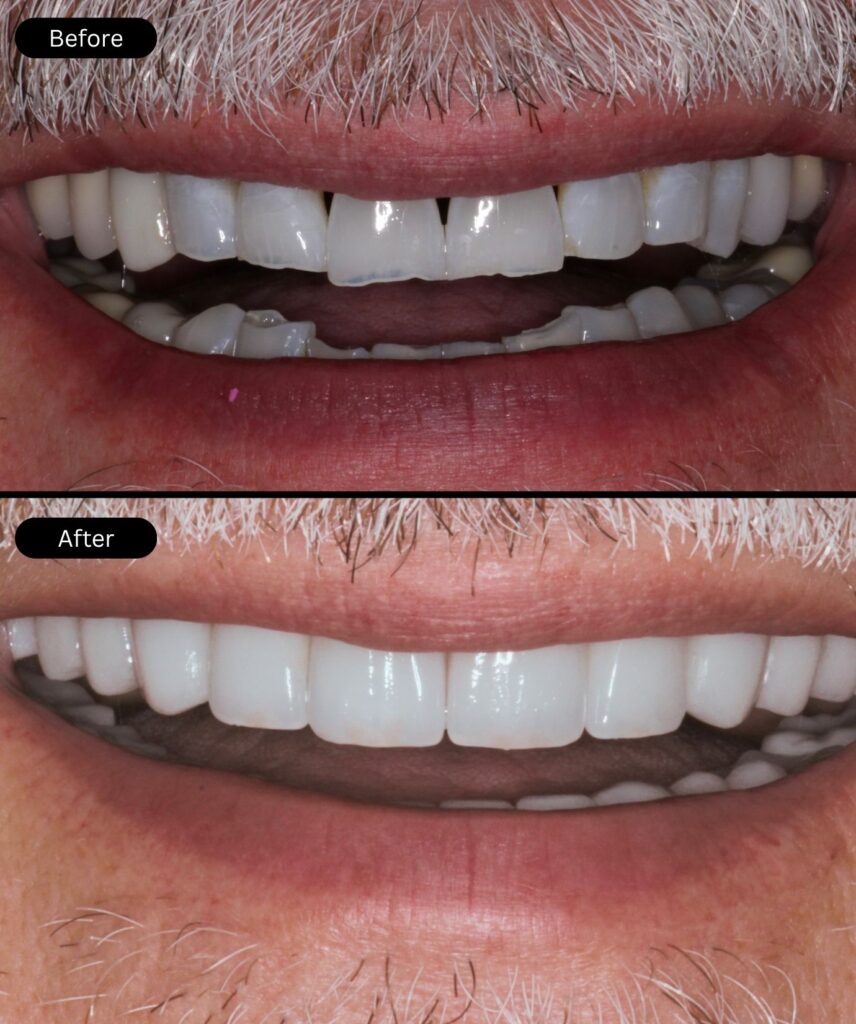 before-after